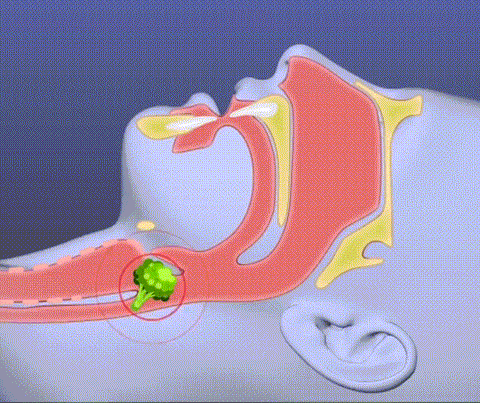 LifeGuard ChokeDefender Kit