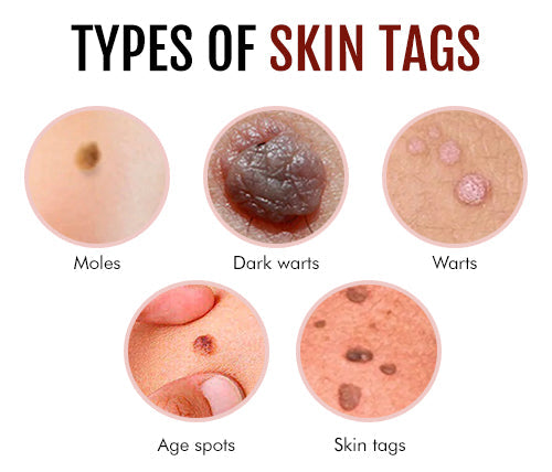 ClearSkin Tag Eraser