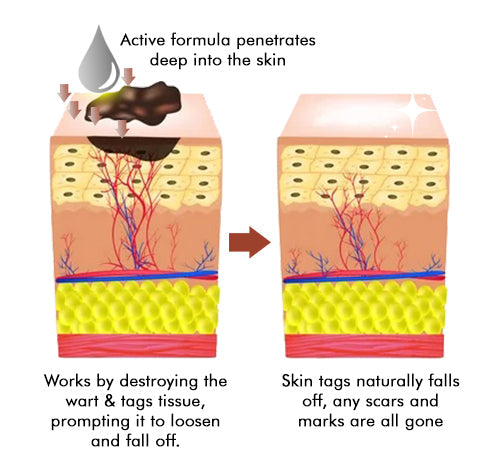 ClearSkin Tag Eraser